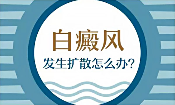 怎样才能防止白癜风扩散呢？